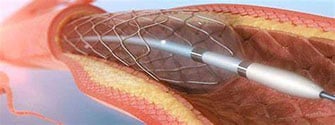 Coronary Angiography